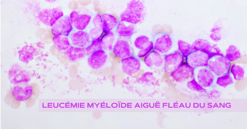 Leucémie myéloïde aiguë - Fléau du sang