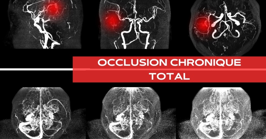 Occlusion chronique total