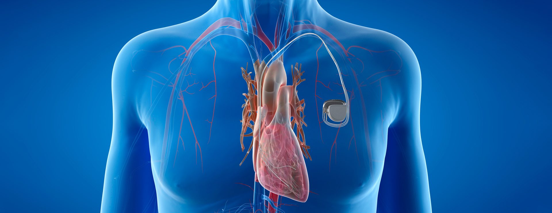 Stimulateur cardiaque - Garant de notre cœur