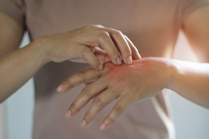 Le sel augmente le risque d-une maladie de peau inflammatoire selon une étude.jpeg