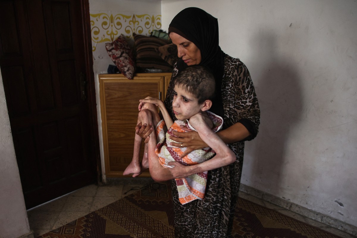 Maladies de peau dangereuses se propagent chez les enfants de Gaza