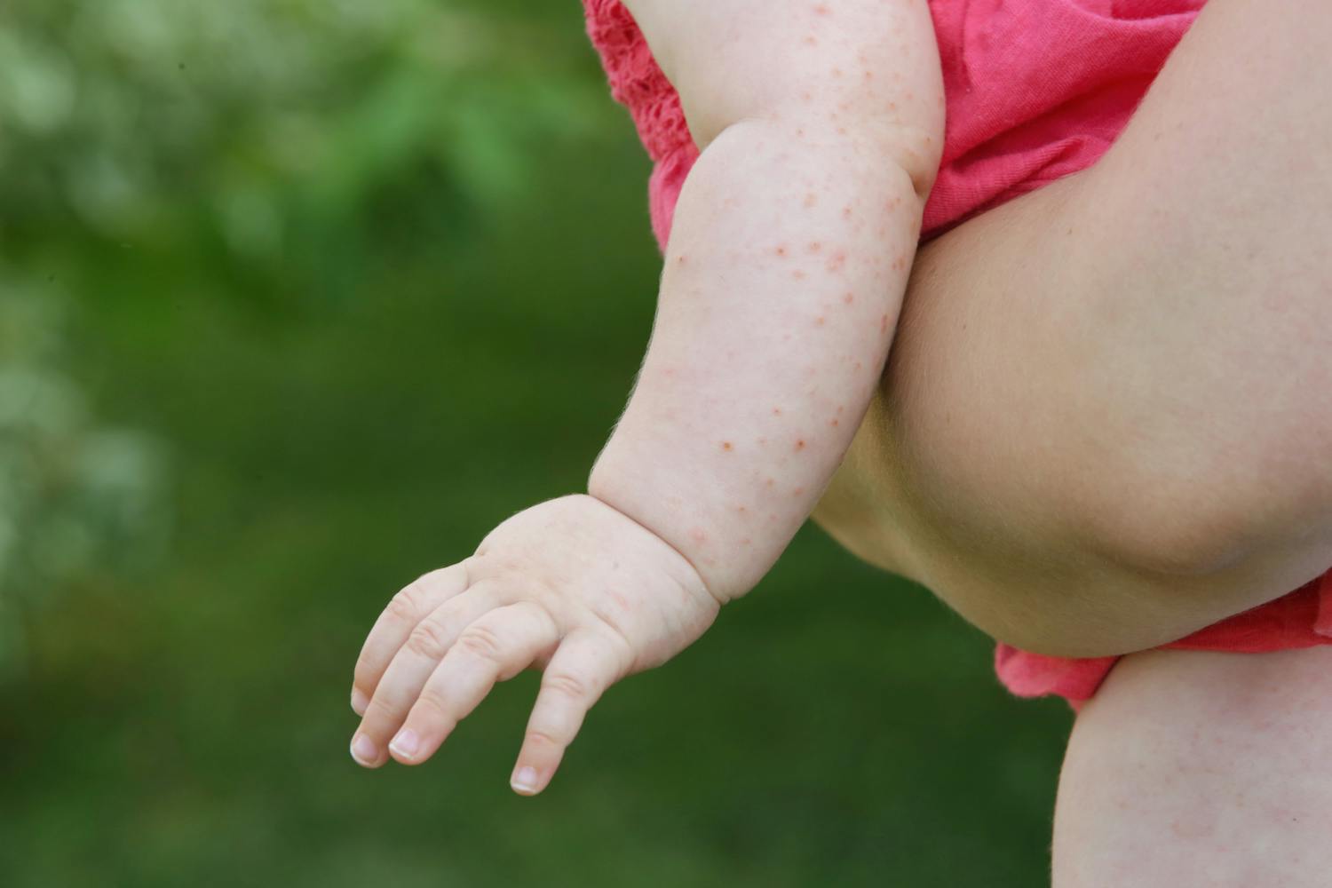 Reconnaître et traiter les boutons de chaleur chez le bébé en été.jpeg